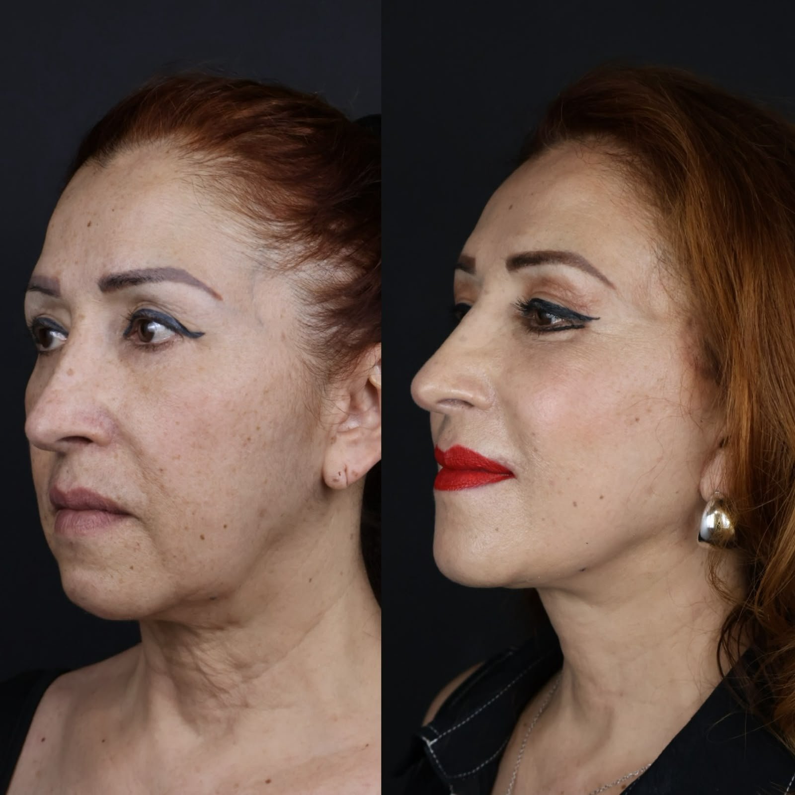Facial