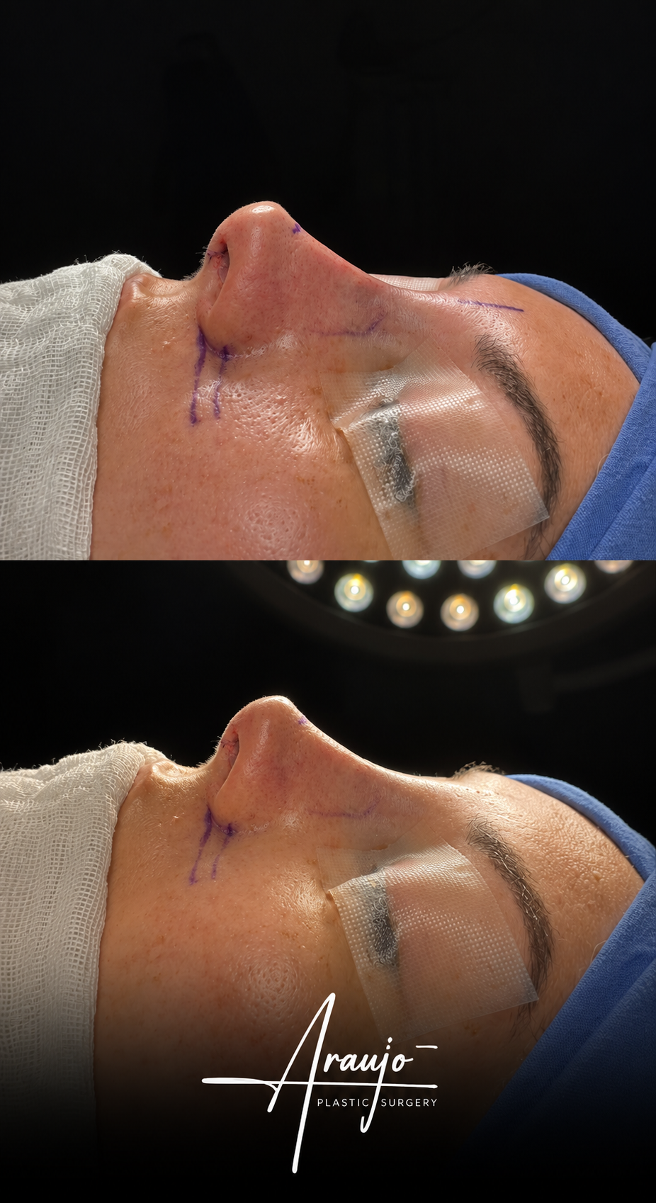 Rinoplastia