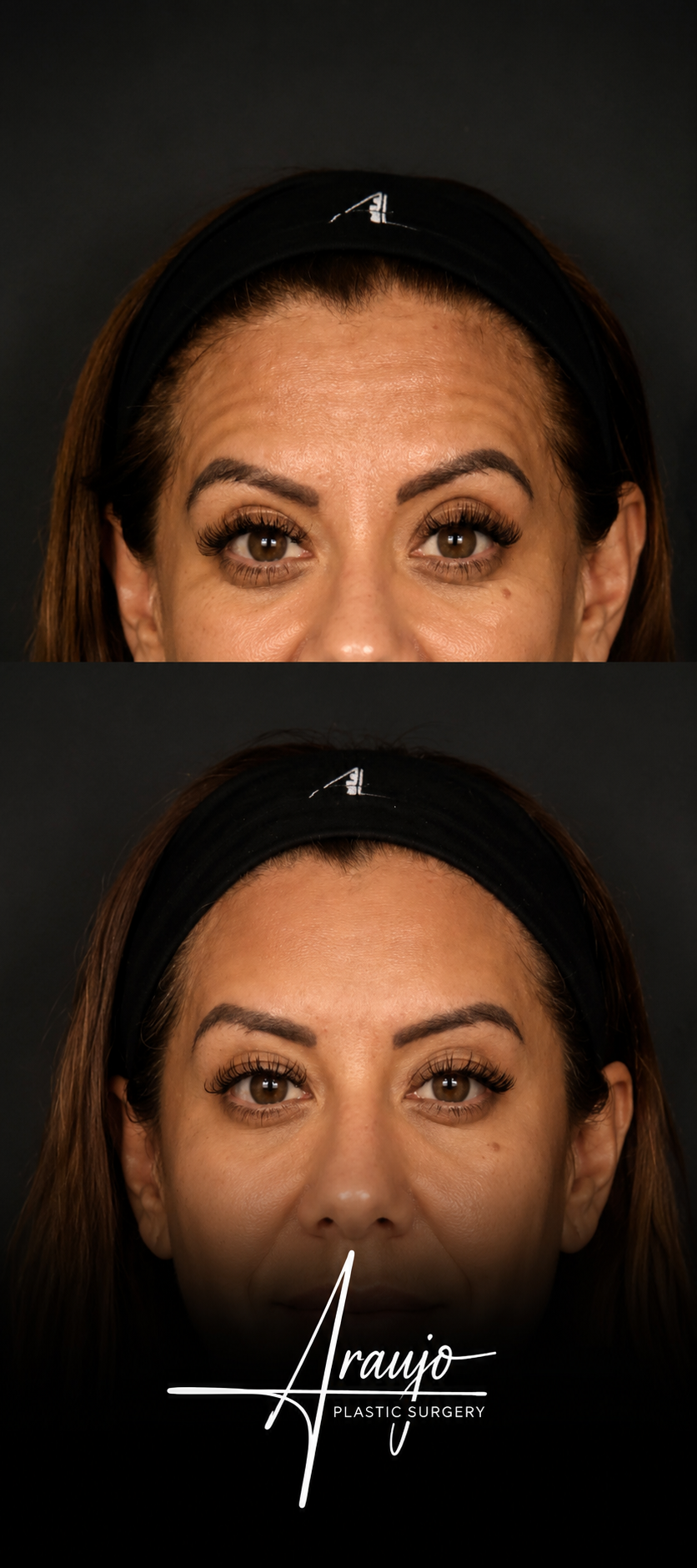 Botox