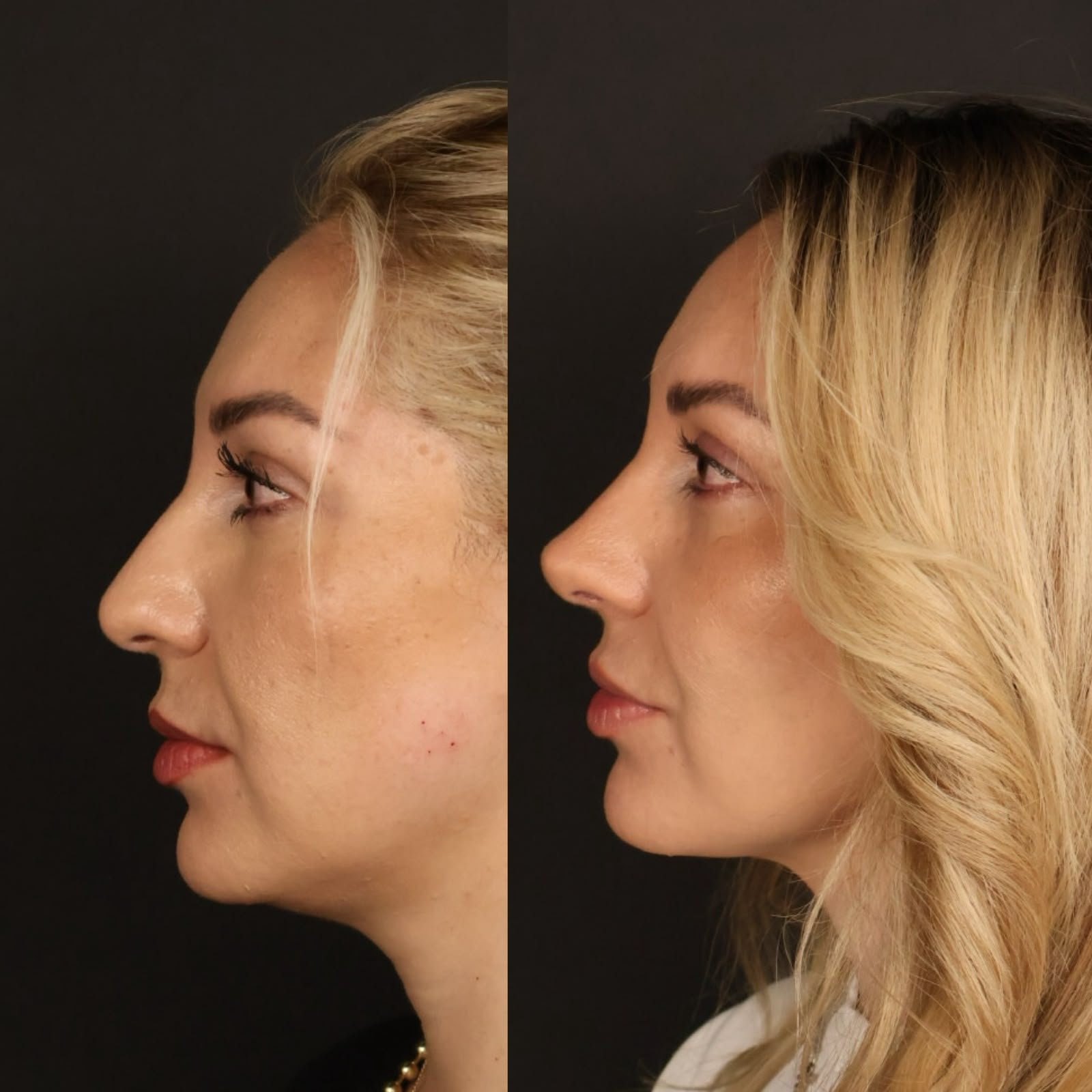 Rinoplastia